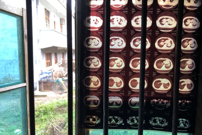 Negatives showing lungs of Wang hang on the window of his room in Sangzhi
